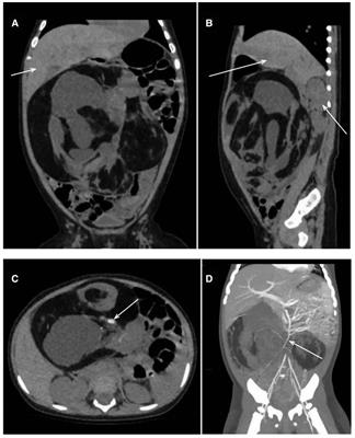 A 6-month-old girl with mesenteric teratoma: A Case report and literature review